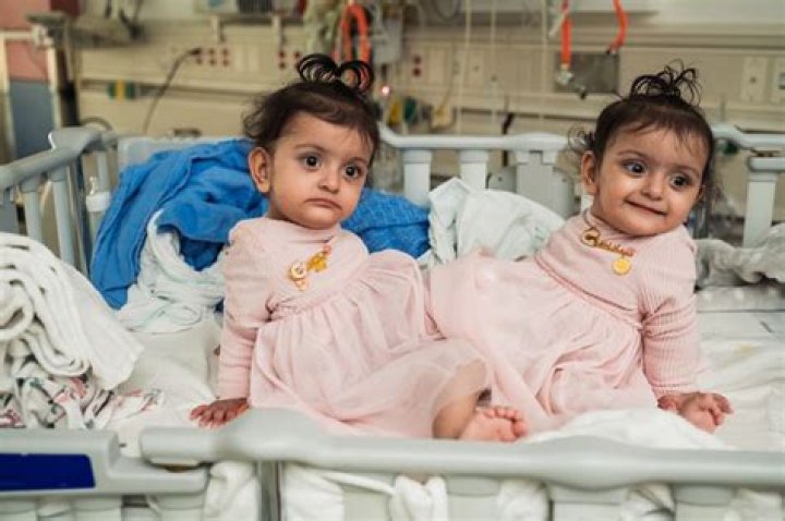 Conjoined twins are finally go home to sleep in separate beds after risky surgery