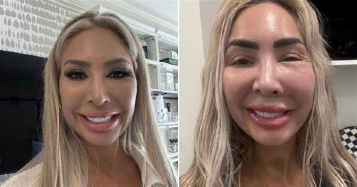 Woman obsessed with plastic surgery has ‘world’s biggest cheeks,’ fans say she needs a ‘brain implant’